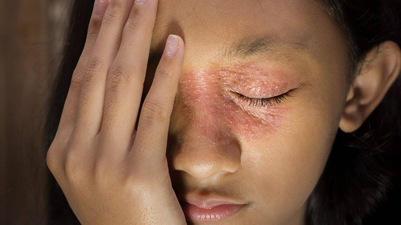 Facial Eczema: শীতে ত্বকের খোসা ওঠা একজিমার লক্ষণ হতে পারে! রইল ৬ সহজ ঘরোয়া টোটকা