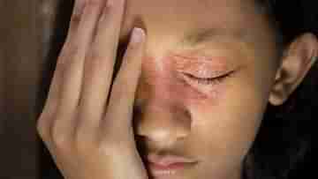 Facial Eczema: শীতে ত্বকের খোসা ওঠা একজিমার লক্ষণ হতে পারে! রইল ৬ সহজ ঘরোয়া টোটকা