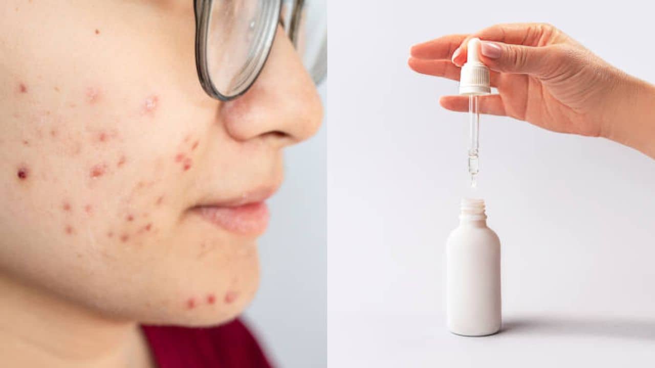 Acne Scars: ব্রণ দাগ দূর করতে ঘরোয়া টোটকা ব্যর্থ? আজ থেকে ট্রাই করুন এই সব ওষুধি পণ্য