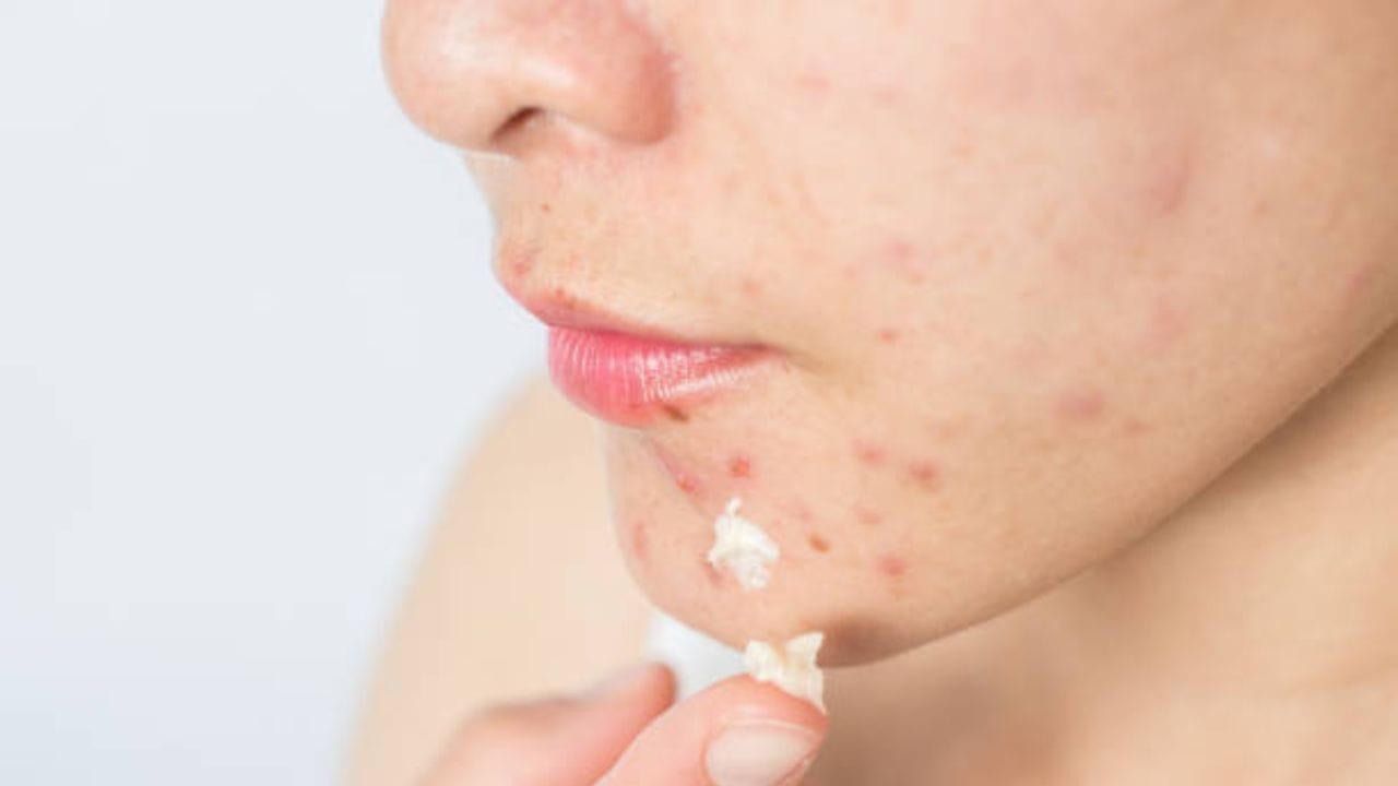 সুন্দর ও স্বাস্থ্যবান ত্বক বজায় রাখার জন্য ক্লিনজিং, টোনিং, ময়েশ্চারাইজিং জরুরি। কিন্তু এতেই সীমাবদ্ধ থাকলে আপনার ব্রণর জেদি দাগ দূর হবে না। ত্বকের দাগছোপ দূর করতে আপনি ঘরোয়া প্রতিকারের উপর ভরসা রাখতে পারেন। 