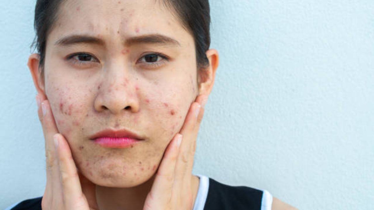 Acne Scars ব্রণর জেদি দাগ দূর করুন রাতারাতি, হেঁশেলের এই উপাদান দিয়ে
