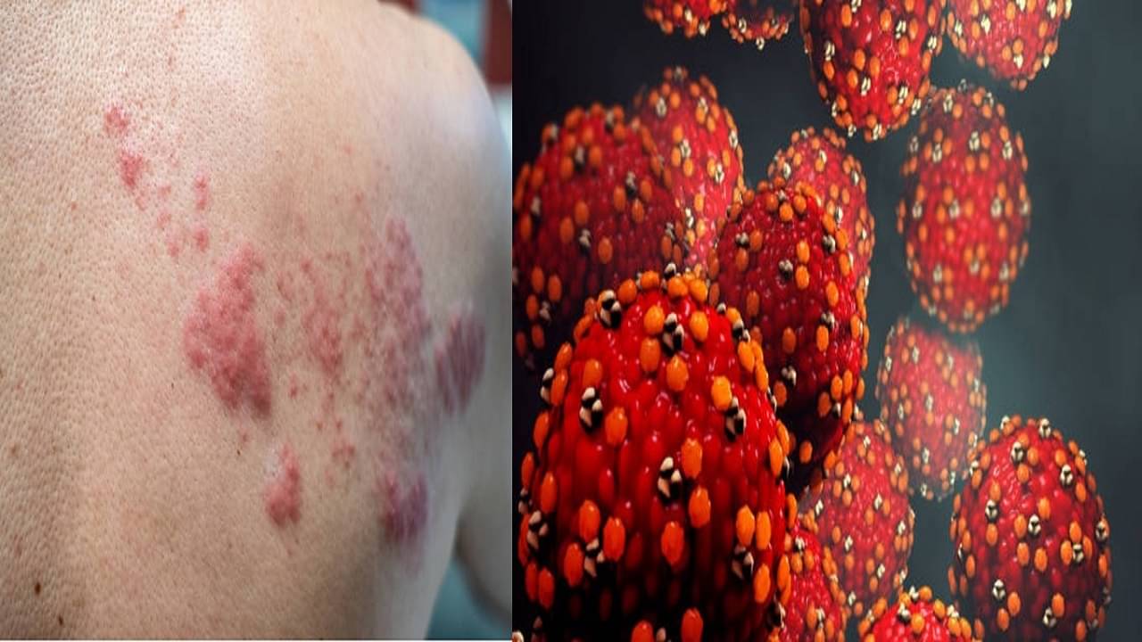 Chicken Pox: কলকাতায় বাড়ছে চিকেন পক্সে মৃত্যু, কীভাবে ছড়ায়, সুস্থ থাকতে কী কী রাখবেন ডায়েটে?