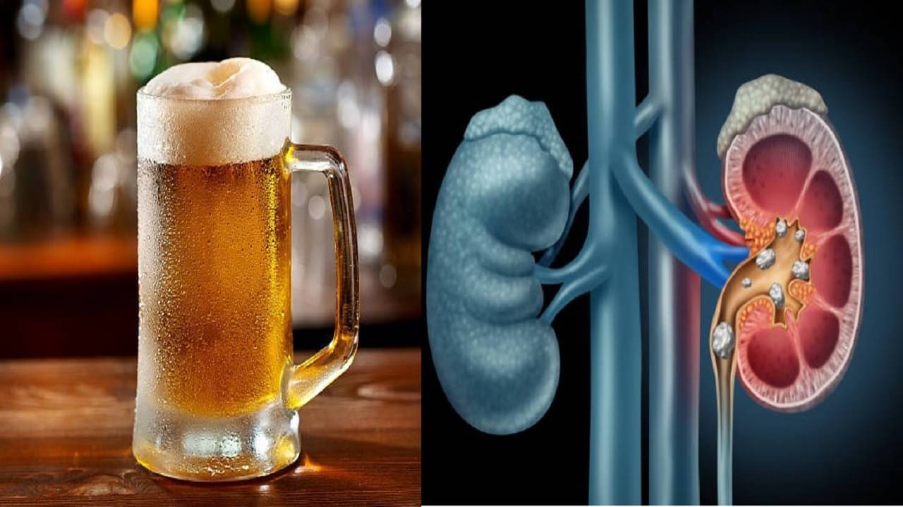 Fact Check: কিডনি স্টোন আর গল স্টোন গলে যাবে স্রেফ এক গ্লাস বিয়ারেই? আদৌ কি সত্যি, জানুন
