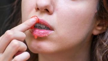 Dark Lips Remedy: রোজ লিপস্টিক ব্যবহারে কালচে হচ্ছে ঠোঁট? লেবু-মধুর সিরামেই আসবে গোলাপী আভা