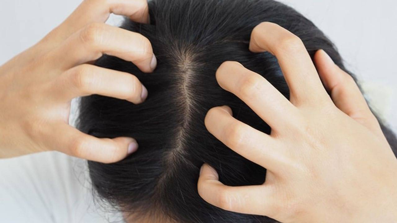 Scalp Eczema: অকারণে মাথা চুলকাচ্ছে? শরীরে একজিমা বাসা বাঁধলো না তো? জেনে নিন এই রোগের লক্ষণ ও প্রতিকার