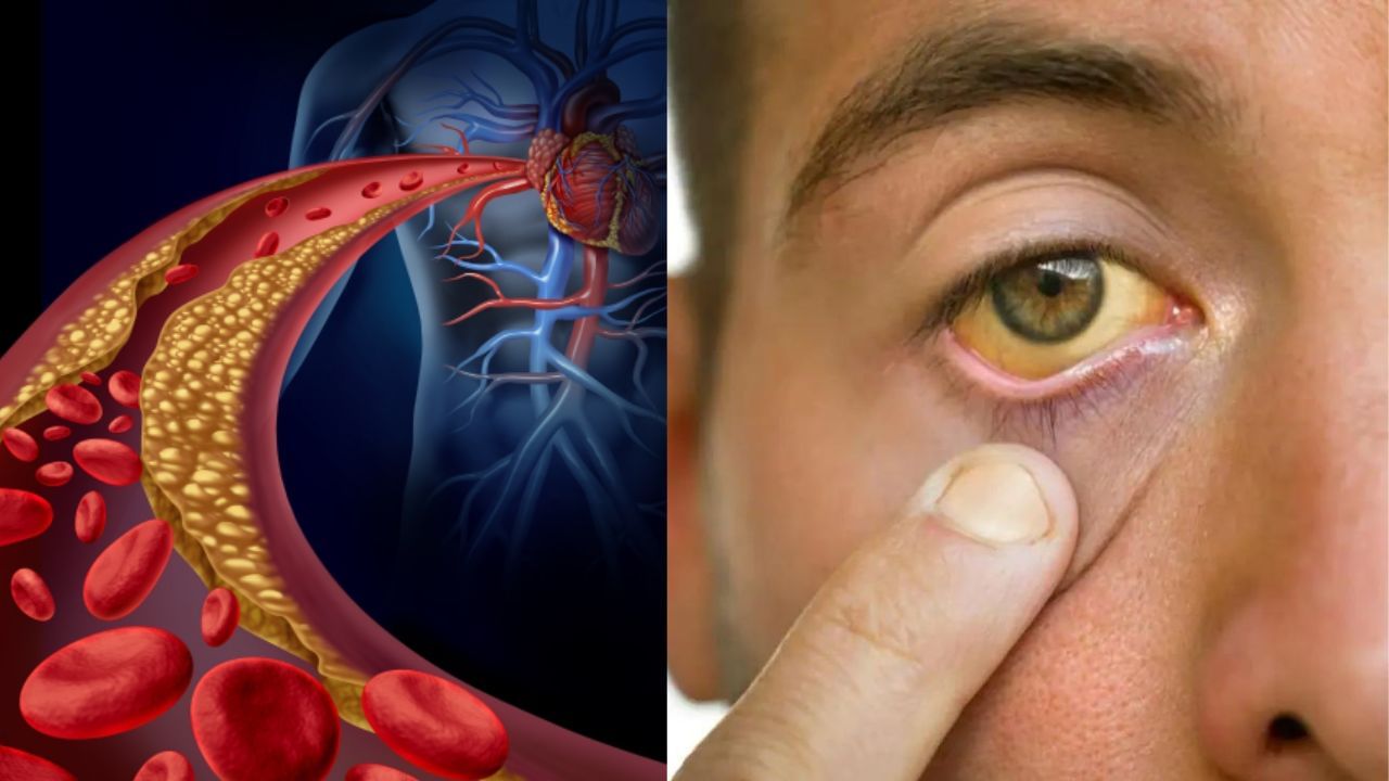 High cholesterol Symptoms চোখের চারপাশে হলুদ দাগ, র‍্যাশ? হতে পারে