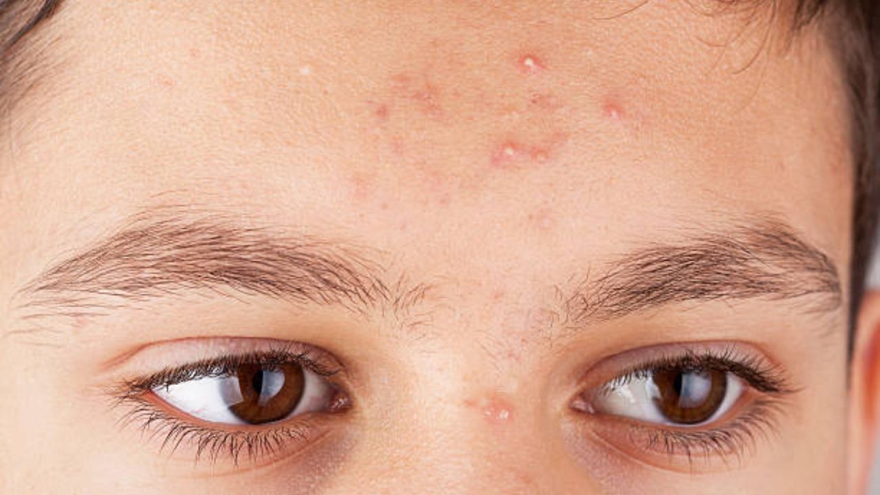 Acne Problem: বিশেষ দিনের আগে মুখভর্তি ব্রণ? ৩ দিনের মধ্যে পিম্পল দূর করুন ঘরোয়া উপায়ে