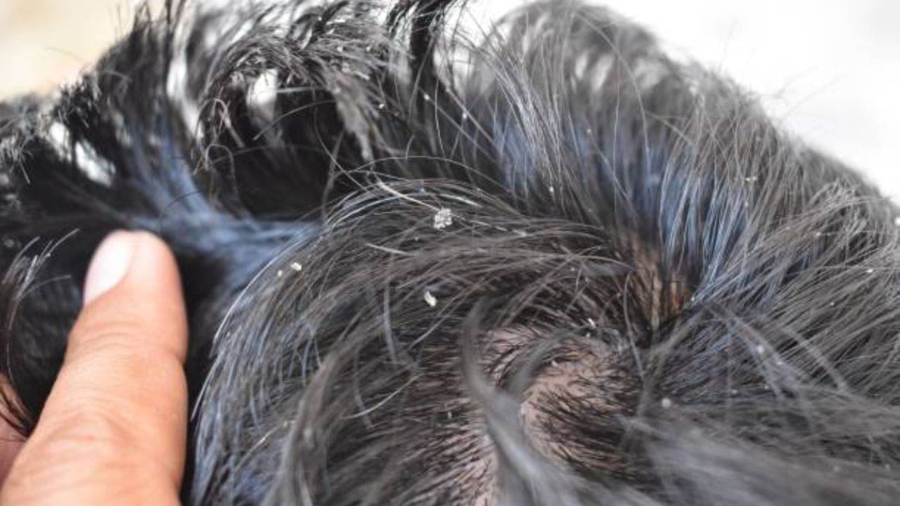 Dandruff Treatment At Home: খুশকি তাড়াতে ঘরোয়া এই ২ উপকরণের কোনও জুড়ি নেই, কমবে চুল পড়াও