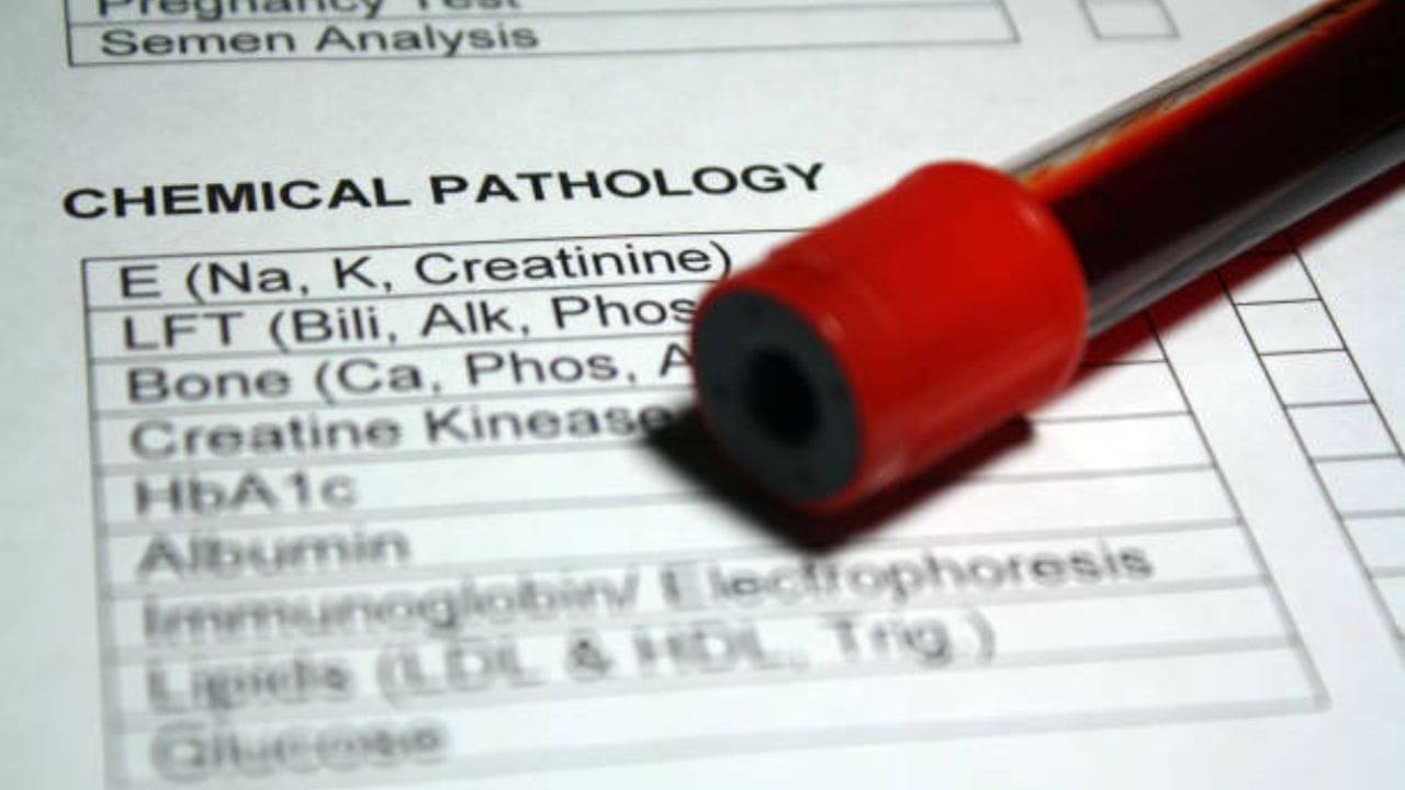 Creatinine Levels: বাড়ছে ক্রিয়েটিনিন? সুস্থ থাকতে যা কিছু অবশ্যই রাখবেন রোজকার পাতে