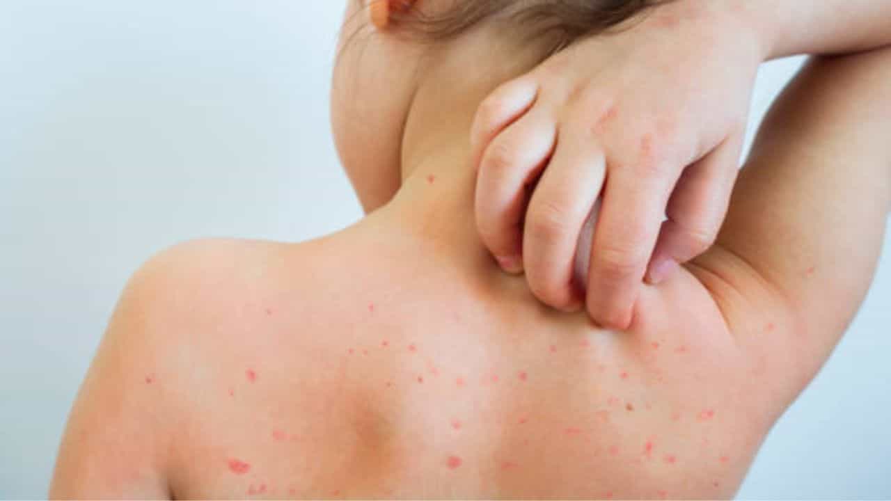 Chicken Pox: সদ্য চিকেন পক্স থেকে সেরে উঠেছেন? দাগ দূর করতে ঘরোয়া প্রতিকার বেছে নিন Chicken Pox: সদ্য চিকেন পক্স থেকে সেরে উঠেছেন? দাগ দূর করতে ঘরোয়া প্রতিকার বেছে নিন