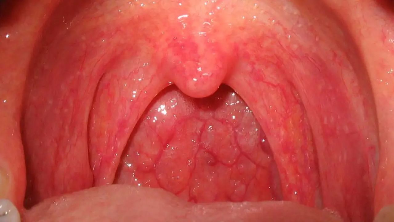 Throat Cancer: বাড়ছে গলার ক্যানসার যেসব লক্ষণ দেখলেই সতর্ক হওয়া জরুরি