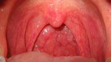 Throat Cancer: বাড়ছে গলার ক্যানসার যেসব লক্ষণ দেখলেই সতর্ক হওয়া জরুরি