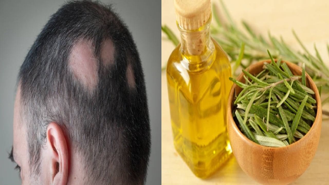 Alopecia Areata Home Remedies: কেন হয় অ্যালোপেসিয়া এরিয়াটা? জানুন এর ঘরোয়া প্রতিকার