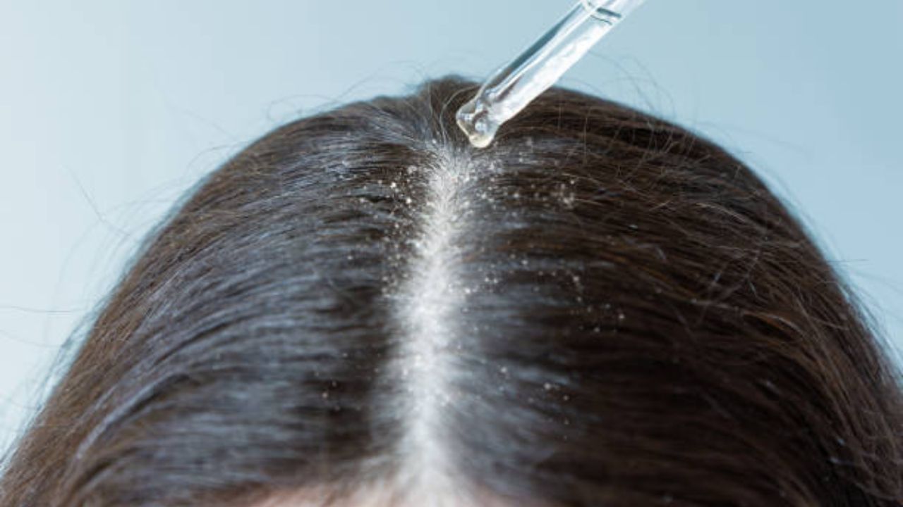 Hair Care with Mustard Oil: খুশকির খেল খতম করতে লেবু নয়, রান্নাঘরের এই ঝঁঝালো তেলই কাফি Hair Care with Mustard Oil: খুশকির খেল খতম করতে লেবু নয়, রান্নাঘরের এই ঝঁঝালো তেলই কাফি