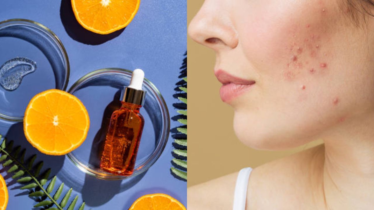 vitamin-c-serum-for-acne-scars