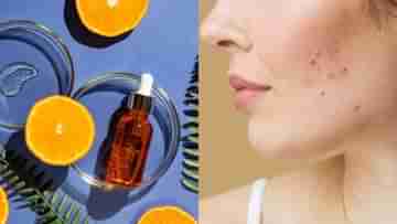 Vitamin C Serum for Acne Scars: এই ভিটামিন থাকুক ডায়েটে ও ড্রেসিং টেবিলে, ব্রণর দাগ থেকে মুক্তি মাত্র ২ সপ্তাহে