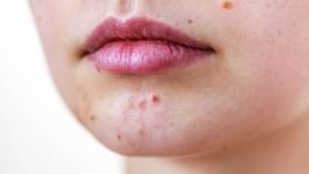 Ayurvedic Treatments for Acne: যখন আয়ুর্বেদিক প্রতিকারই সেরা, এক সপ্তাহে ব্রণ থেকে রেহাই পাবেন গ্যারান্টি Ayurvedic Treatments for Acne: যখন আয়ুর্বেদিক প্রতিকারই সেরা, এক সপ্তাহে ব্রণ থেকে রেহাই পাবেন গ্যারান্টি