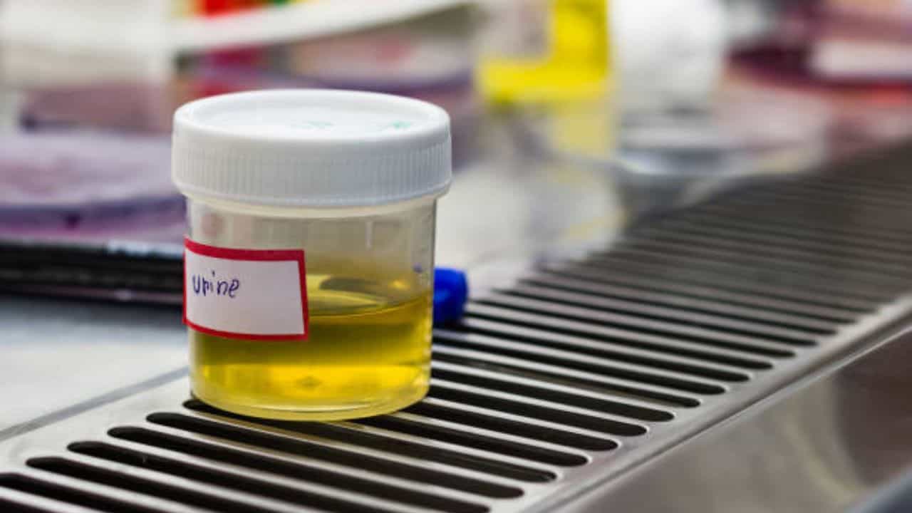 Uric Acid Symptoms In Urine: প্রস্রাবের এই ৩ লক্ষণ দেখলেই বুঝবেন যে রক্তে বেড়েছে ইউরিক অ্যাসিড Uric Acid Symptoms In Urine: প্রস্রাবের এই ৩ লক্ষণ দেখলেই বুঝবেন যে রক্তে বেড়েছে ইউরিক অ্যাসিড
