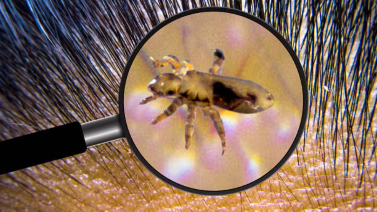 Remove Lice: উকুনের জ্বালায় অস্থির? শ্যাম্পুর সঙ্গে বেছে নিন এই ঘরোয়া প্রতিকার, ফল পাবেন ১ সপ্তাহে