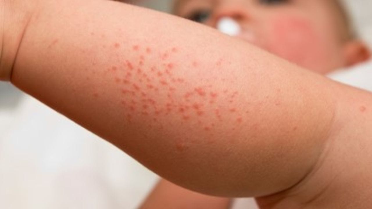 Heat Rash Cure: ভ্যাপসা গরমে ত্বকে লাল-লাল ব়্যাশে ভরে যাচ্ছে ...