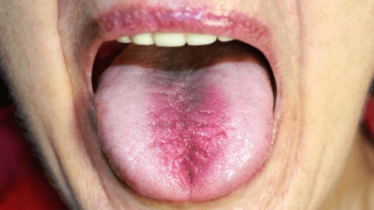 Vitamin D Deficiency জিভে ঘনঘন ঘা হচ্ছে? ভিটামিন Dএর অভাবে শরীরে বাসা