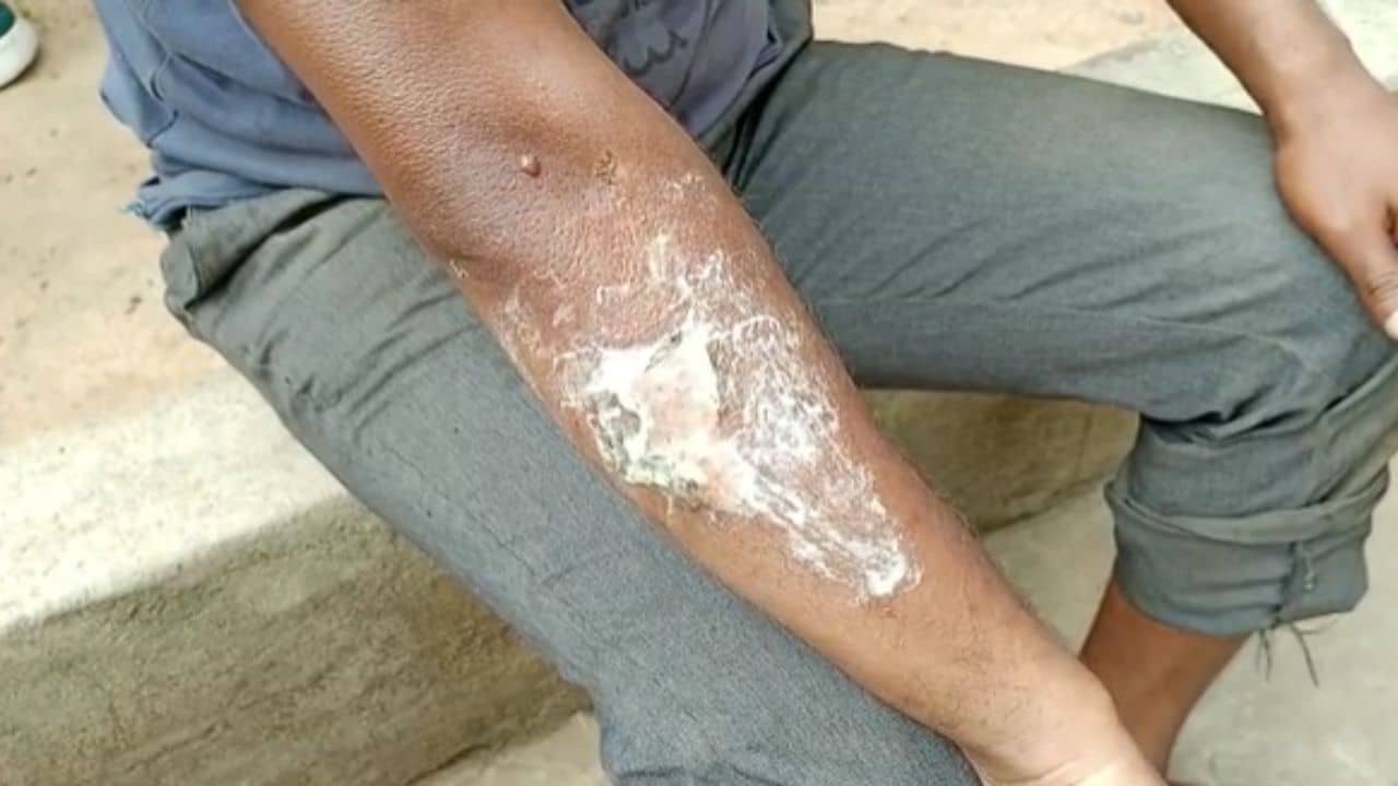 Bankura: গলন্ত লোহায় ঝলসেছিল শরীরের ৯০ শতাংশ, মৃত্যু স্পঞ্জ আয়রন কারখানার ২ শ্রমিকের, বাকিরাও আশঙ্কাজনক