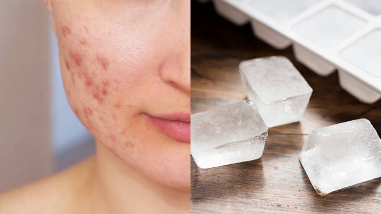 Ice Cube for Acne ব্রণর ব্যথায় কষ্ট পাচ্ছেন? মুখের উপর বরফ চেপে ধরুন, মিলবে চটজলদি আরাম