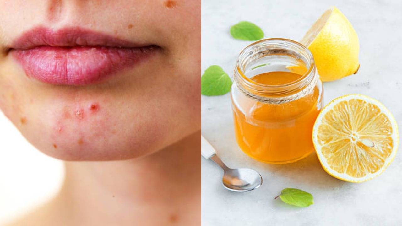 Lemon-Honey: রোদে বেরিয়ে ত্বক ঝলসে গিয়েছে? হেঁশেলের এই দুই উপাদানে মিলবে স্বস্তি