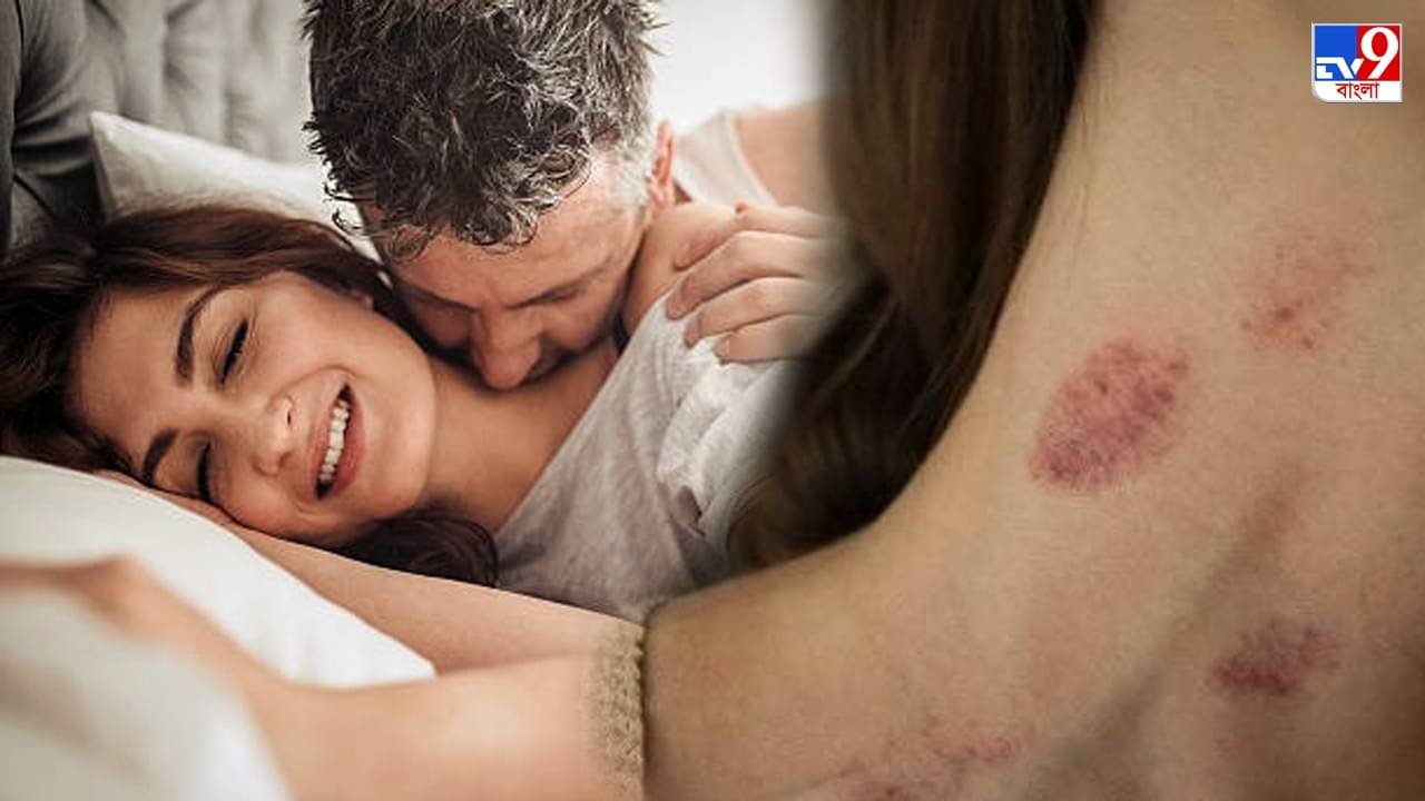 Love Bite: ঘাড়ে, গলায়, বুকে প্রেমের দাগ? সহজ টোটকায় ঢেকে ফেলুন গোপন কালশিটে