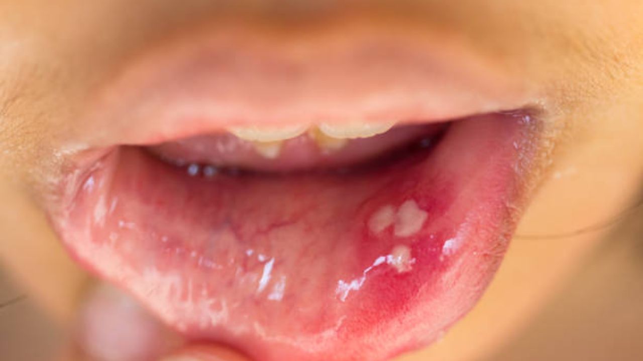 mouth-ulcer