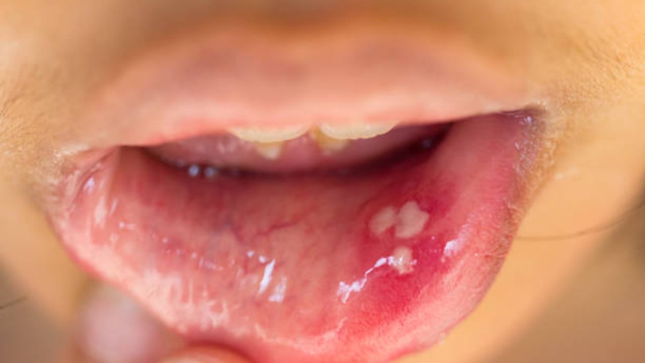 Mouth Ulcer: মুখের ভিতর দগদগে ঘা? কোনও পুষ্টির ঘাটতি নাকি সংক্রমণের লক্ষণ, জানুন মুক্তির উপায়