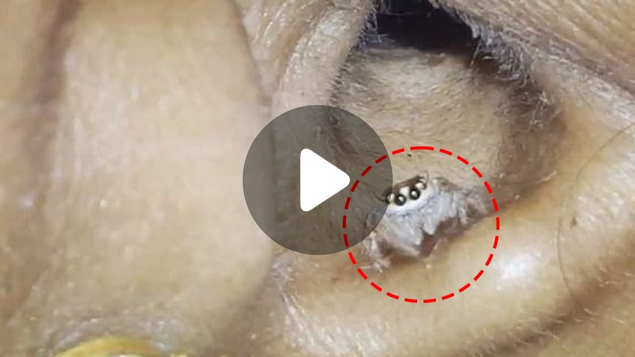 Sprider Inside Woman's Ear: কানের ভিতর জাল বুনেছে মাকড়সা!