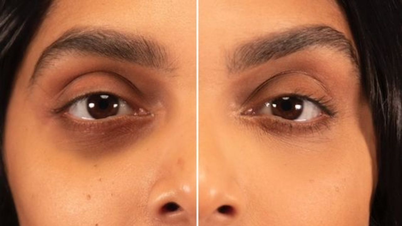 Dark Circle: চোখের তলায় গাঢ় হচ্ছে কালো দাগ? নজরটা ঘোরান হেঁশেলের দিকে Dark Circle: চোখের তলায় গাঢ় হচ্ছে কালো দাগ? নজরটা ঘোরান হেঁশেলের দিকে