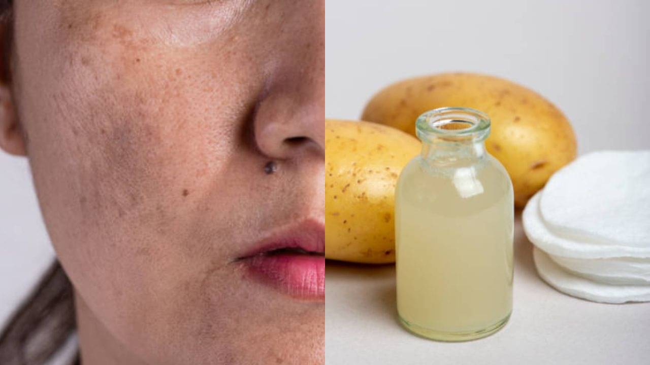 Potato for Dark Spot: মুখে কালচে দাগ ক্রিমে যাচ্ছে না? ত্বকের আলু ঘষতে পারেন এভাবে