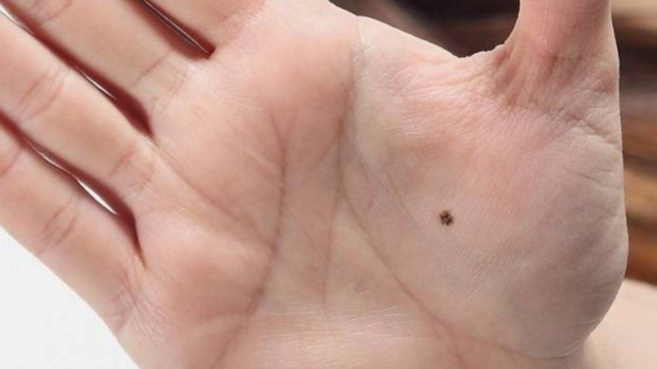 Lucky Moles: শরীরের এই অংশে তিল কোন সৌভাগ্যের ইঙ্গিত দেয়? জানুন সমুদ্রবিদ্যা