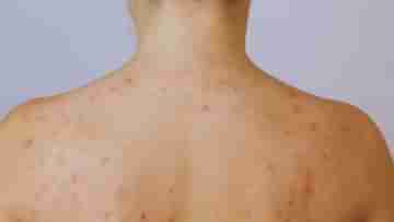 Neck Acne: পিঠ ভর্তি ব্রণ? হাতিয়ার লুকিয়ে হাতের কাছেই