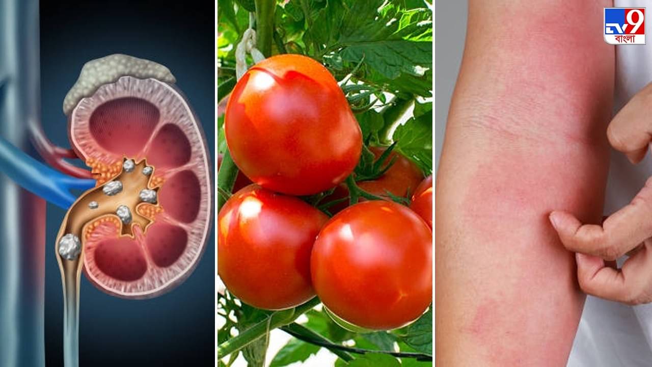 Tomato in Ayurveda: এই ৫ রোগ থাকলে ভুল করেও টমেটো নয়, খেলেই বিপদ আসন্ন