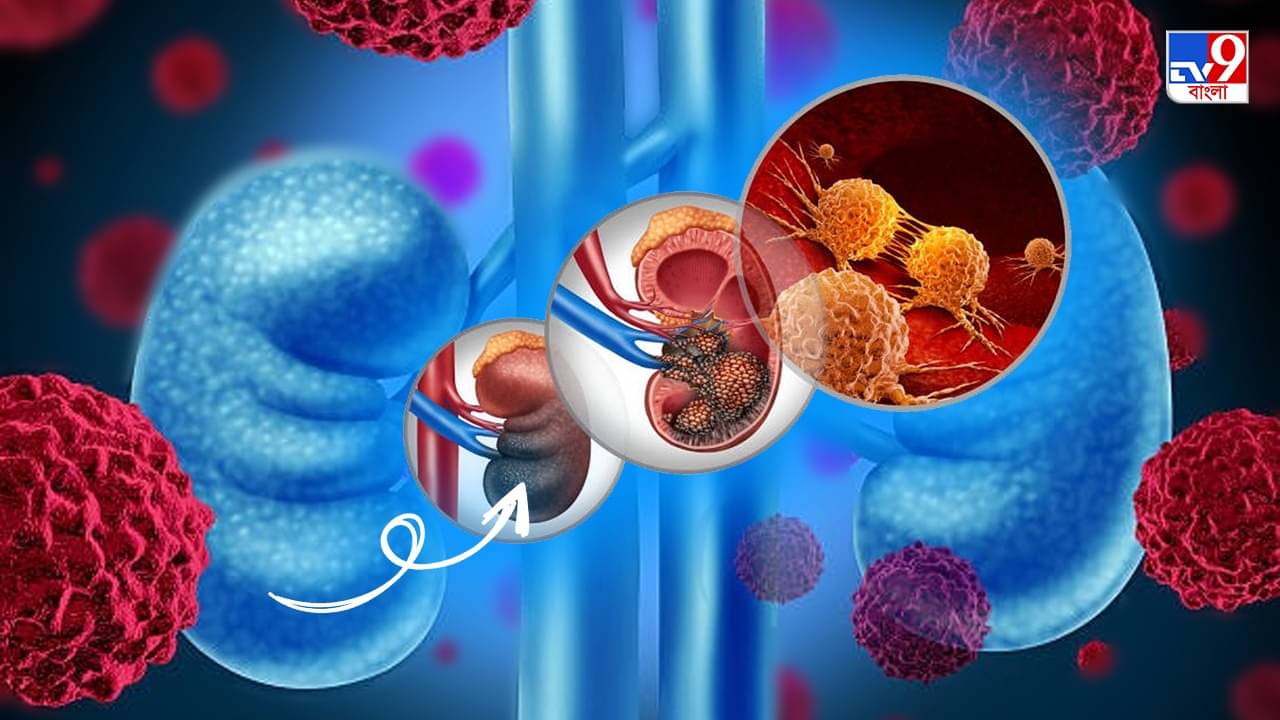 Kidney Cancer Symptoms: কিডনি ক্যানসারের যে সব লক্ষণ একমাত্র রাতেই দেখা যায়, হতে হবে সতর্ক