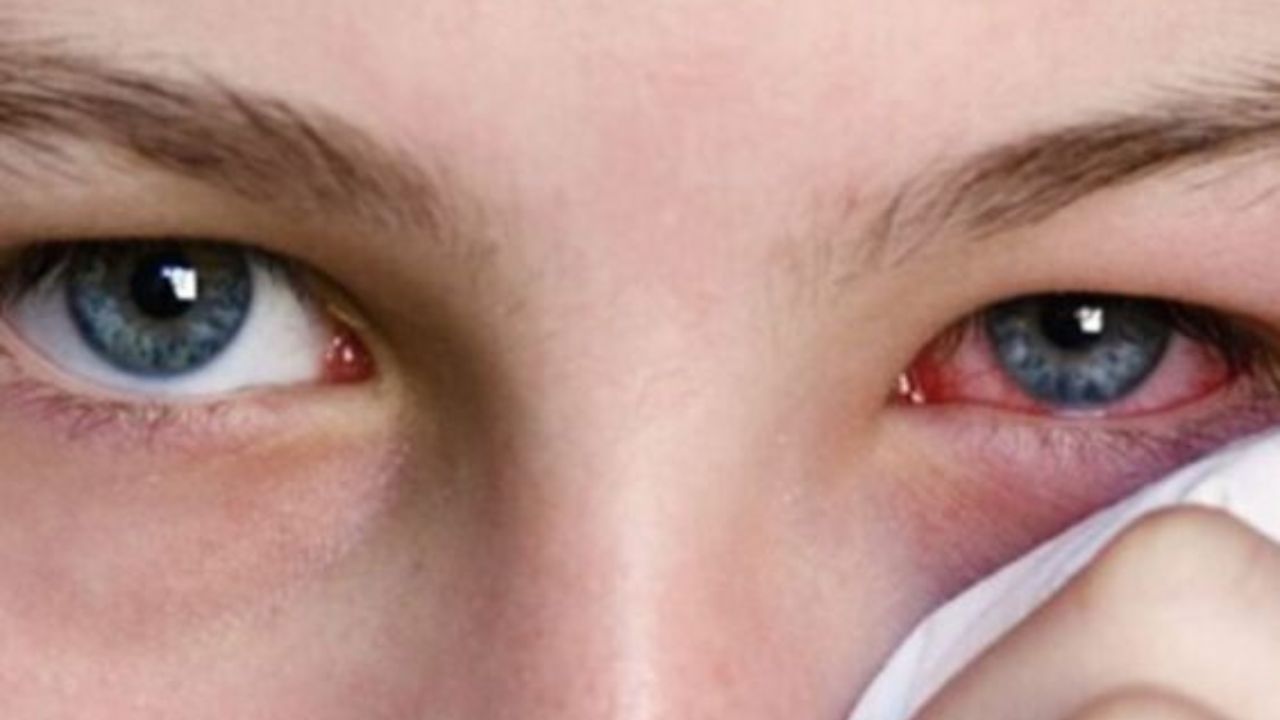 conjunctivitis-care