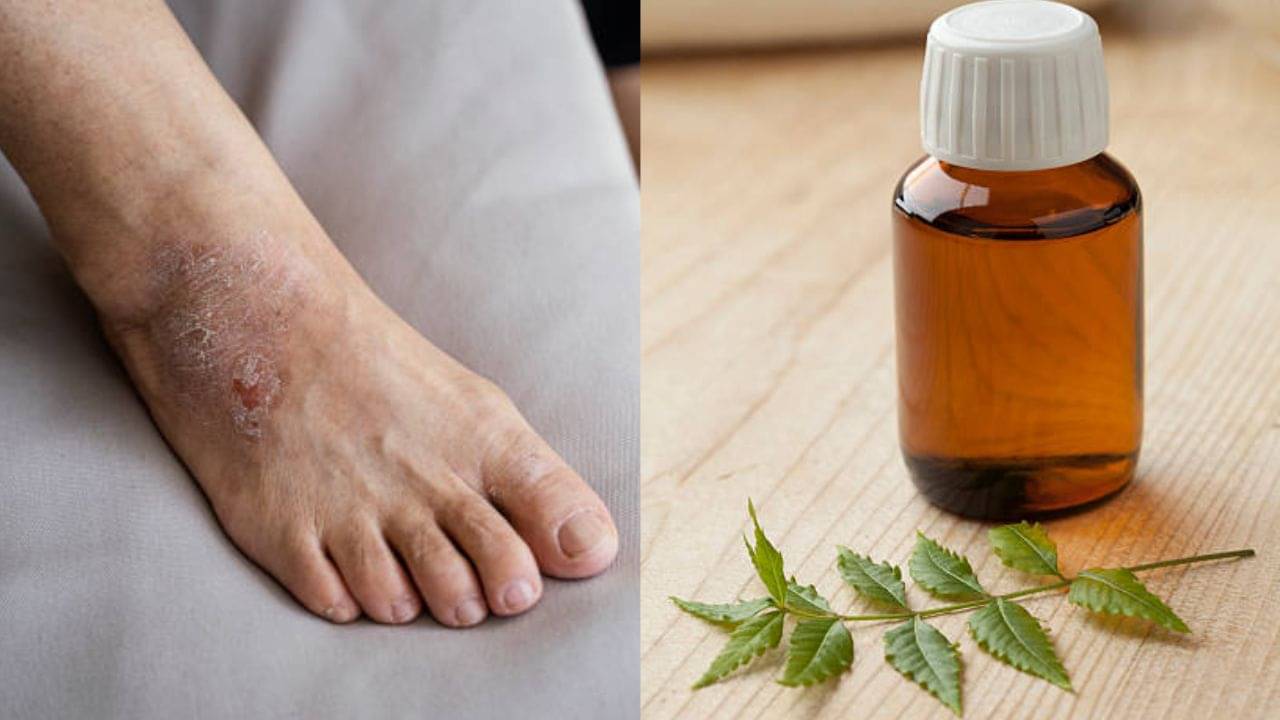 Neem Oil for Skin: পায়ে কাদা লেগে ঘা হয়েছে? সারিয়ে তুলুন নিম তেল দিয়ে