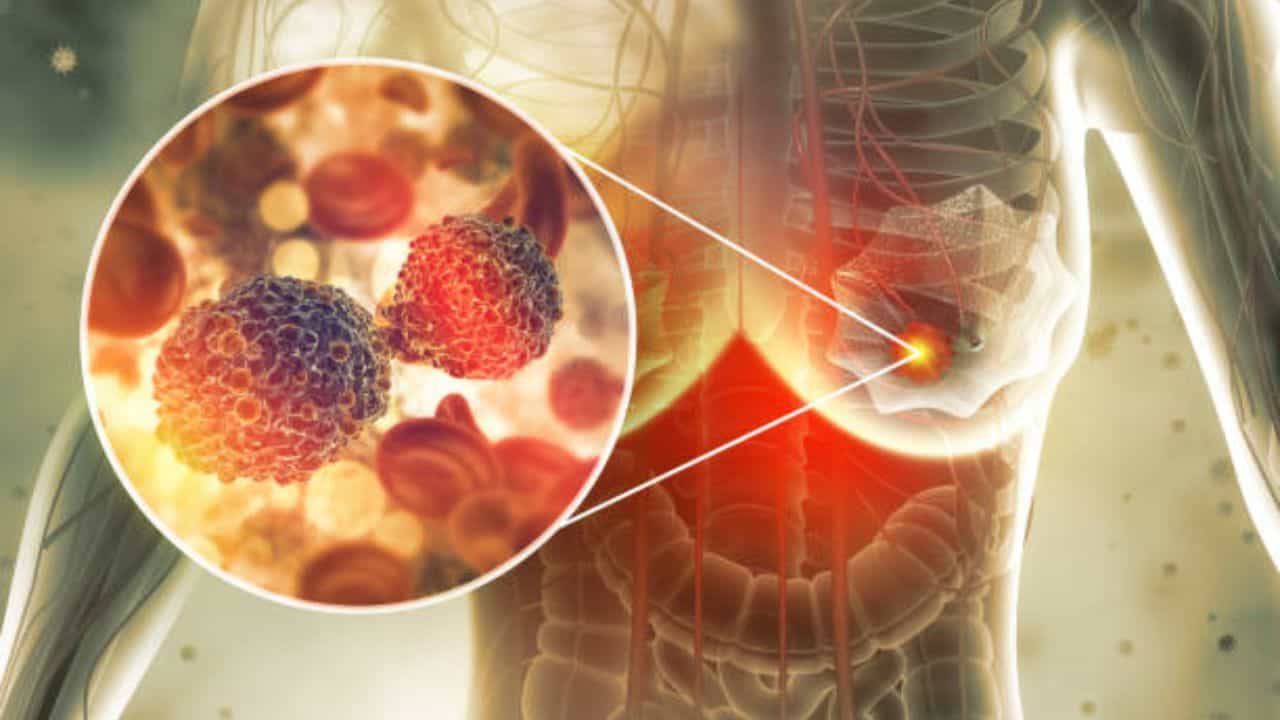 Cancer: টিউমার মানেই কি ক্যানসার? জানুন আসল সত্য Cancer: টিউমার মানেই কি ক্যানসার? জানুন আসল সত্য