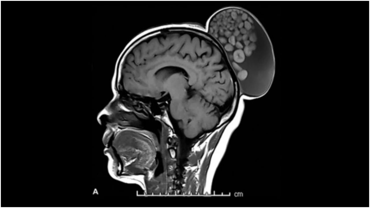 Bengaluru: ছোটবেলা থেকেই ফোলার শুরু, বেঙ্গালুরুর মহিলার মাথা থেকে বের হল 'মার্বেলের থলি'