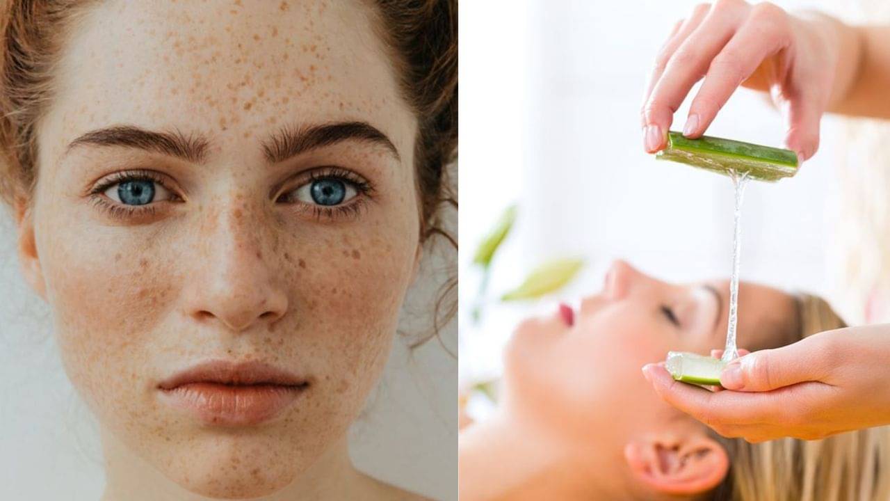 Dark Spot: মুখ ভরেছে কালো দাগে? ভরসা রাখুন ঘরোয়া কিছু উপায়ে