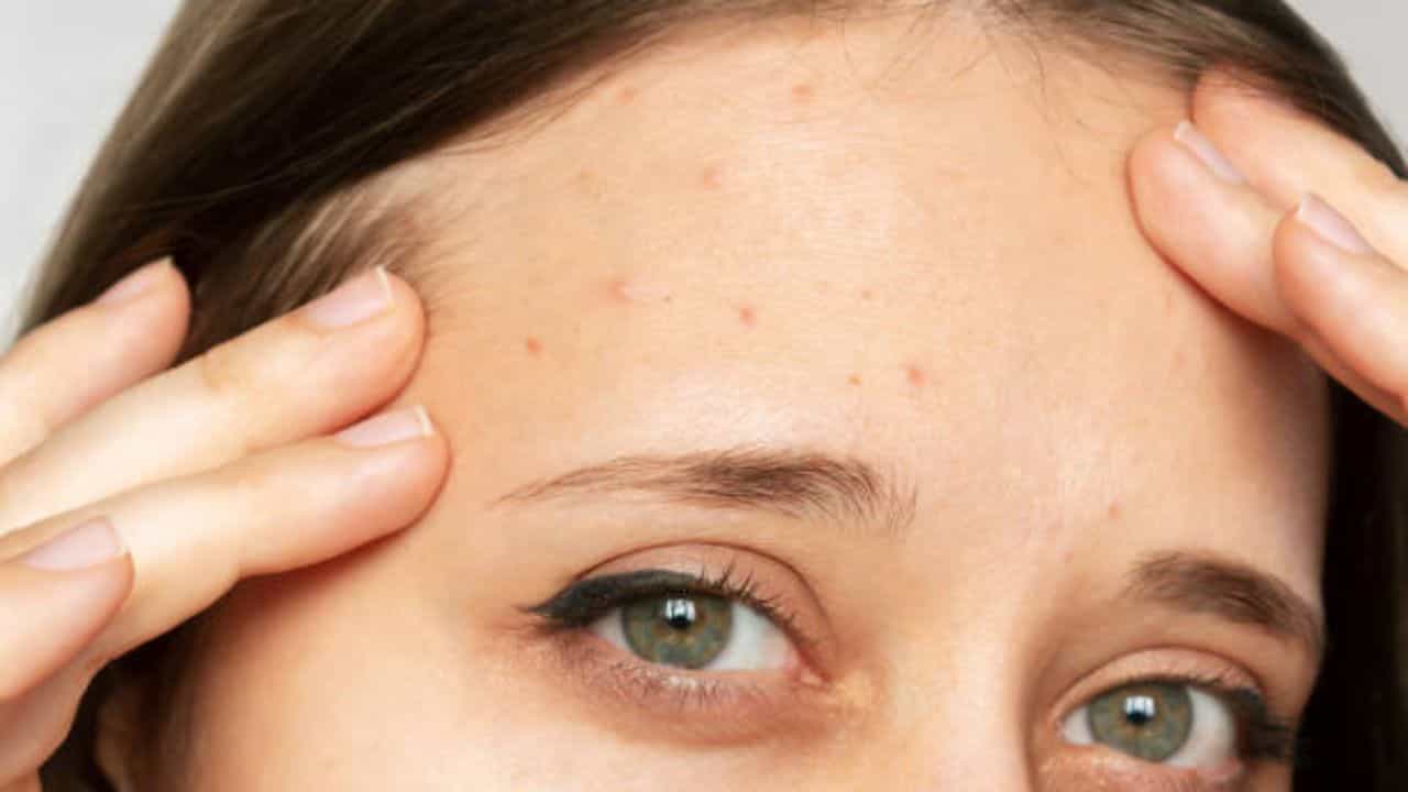 Forehead Acne: কপাল জুড়ে ব্রণ? ৪ টোটকা মানলেই কমবে ত্বকের সমস্যা Forehead Acne: কপাল জুড়ে ব্রণ? ৪ টোটকা মানলেই কমবে ত্বকের সমস্যা