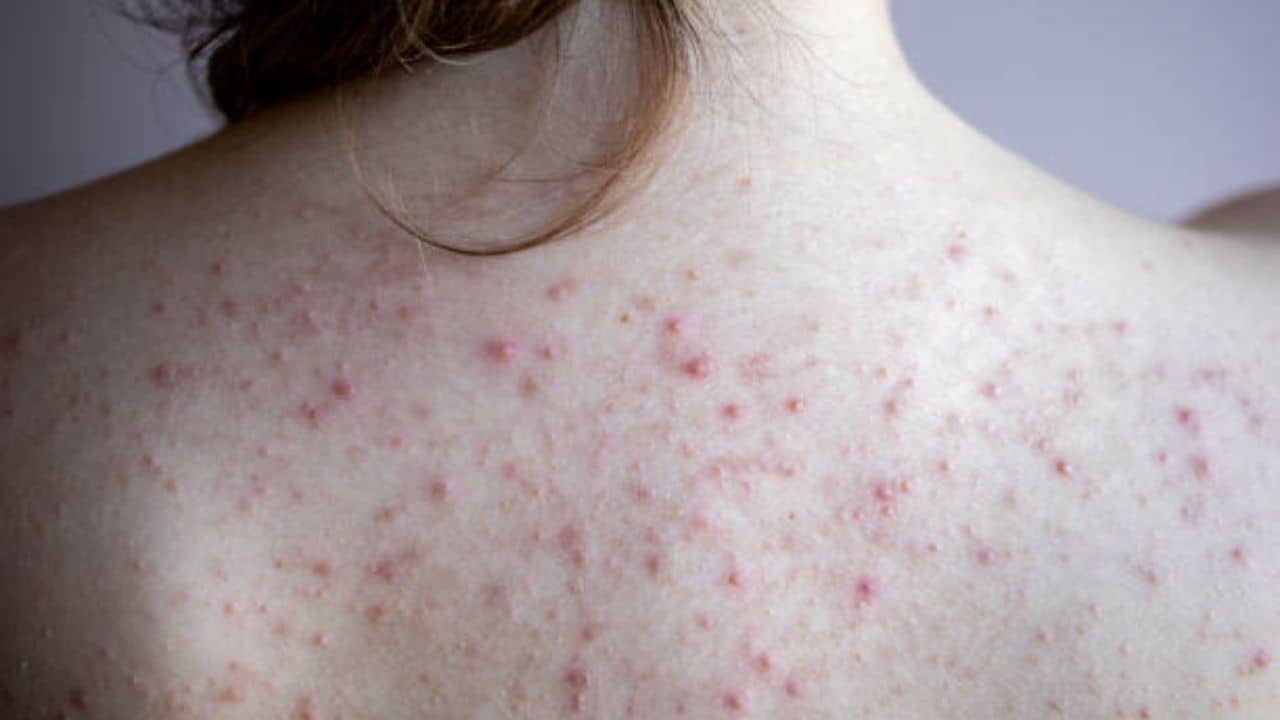Back Acne: দাগছোপ ছাড়াই পুজোয় পরুন ব্যাকলেস ড্রেস, পিঠের ব্রণ তাড়ান সহজ উপায়ে