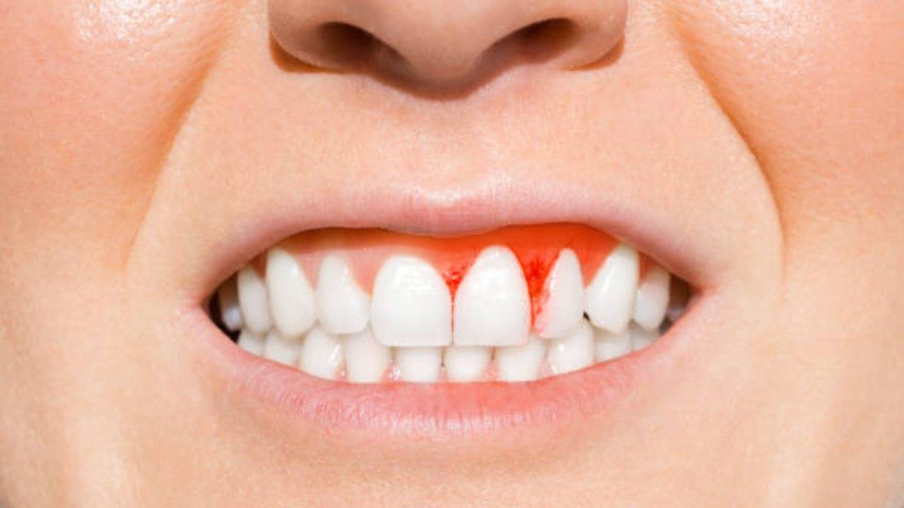 Gum Bleeding: নিয়ম করে দিনে ২বার ব্রাশের পরেও মাড়ি দিয়ে রক্ত পড়ছে? রোজকার এই সমস্যা থেকে মুক্তি যেভাবে...