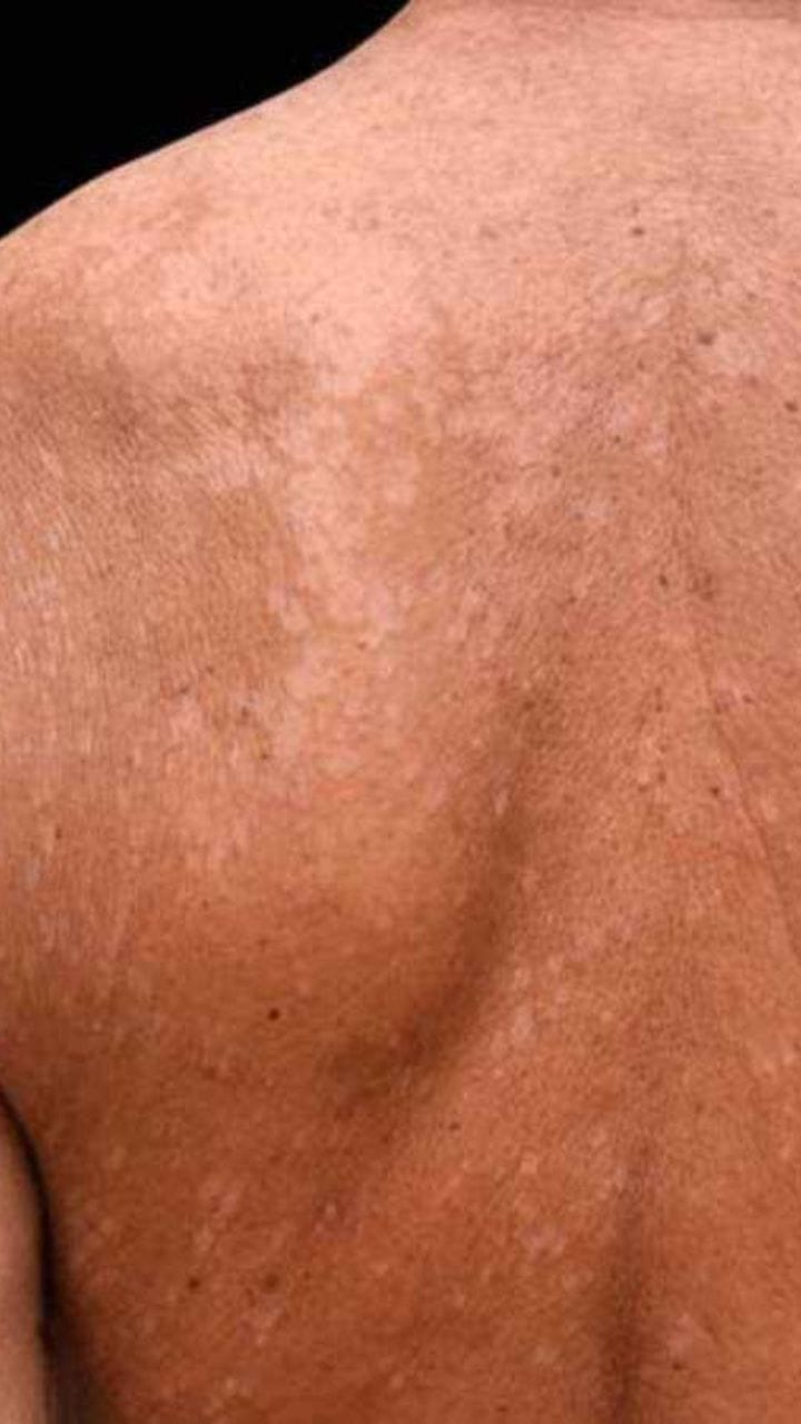 ছুলির সমস্যা? রইল সমাধান TV9Bangla