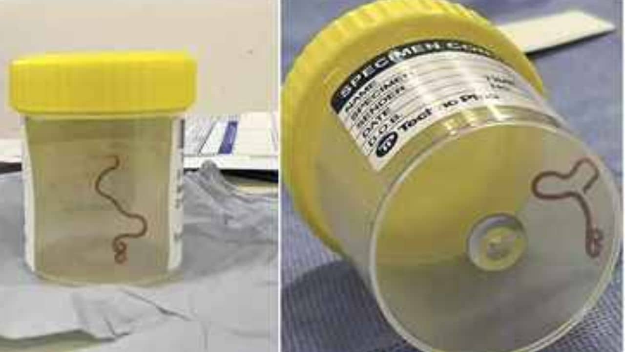 Worm Found: মহিলার মাথায় কিলবিল করছে কৃমি, দুনিয়ায় প্রথমবার এমন ঘটনা ঘটল