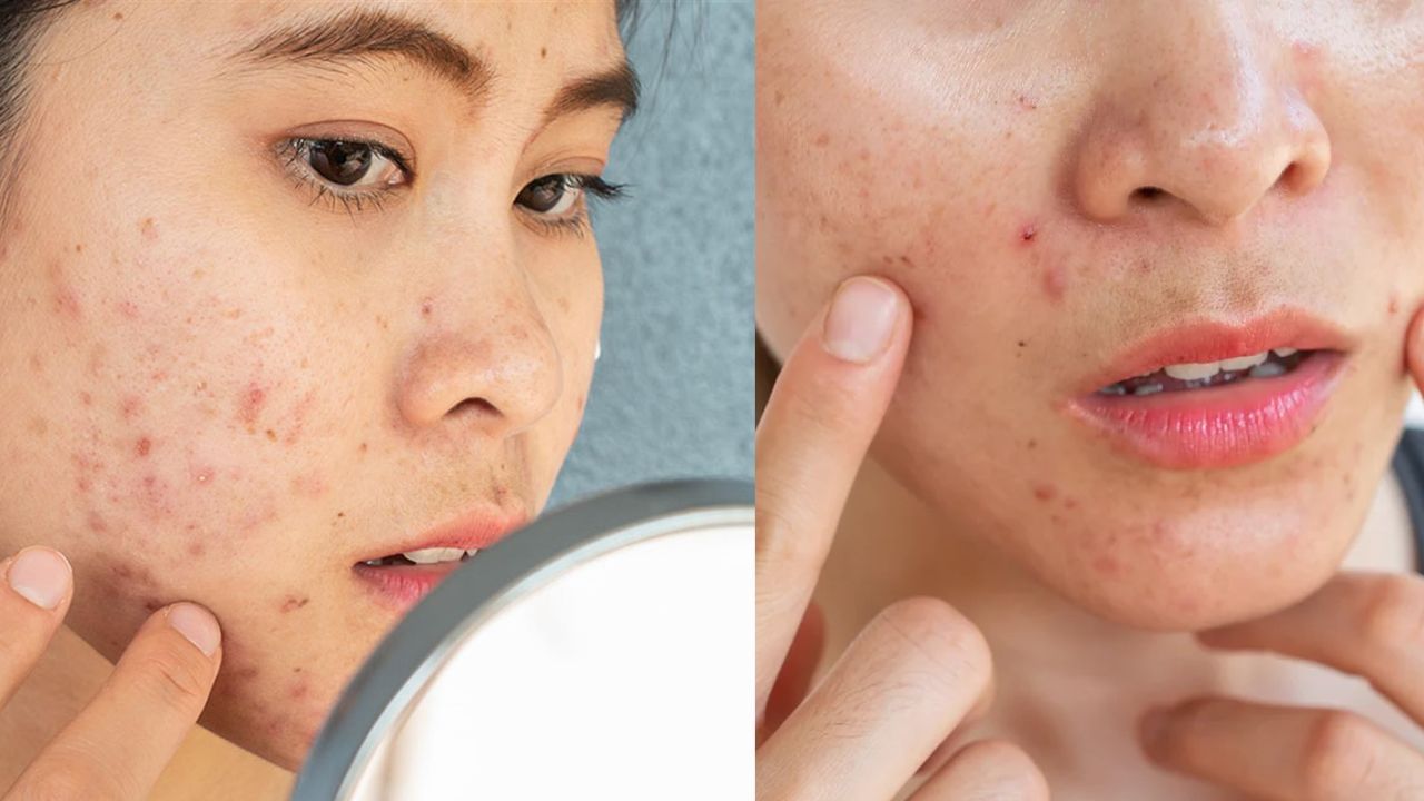 Acne Care ব্রণর সমস্যায় জর্জরিত? সমস্যা এড়াতে কী ডায়েট মেনে চলবেন