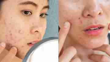 Acne Care: ব্রণর সমস্যায় জর্জরিত? সমস্যা এড়াতে কী ডায়েট মেনে চলবেন? জানুন